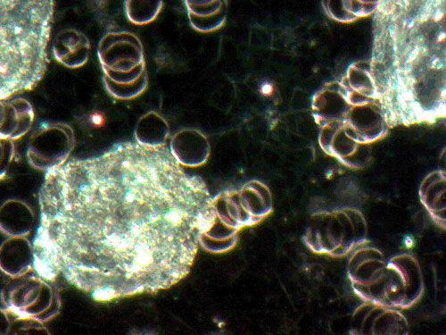 live blood test results, yeast, aspergillus mold, live blood analysis